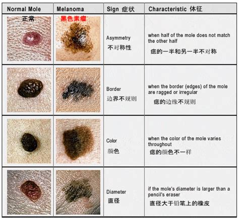 痣變色|身上的痣突然变化，要当心！25 条医生想告诉你的健。